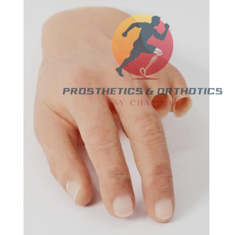 Tay thẩm mỹ mất ngón